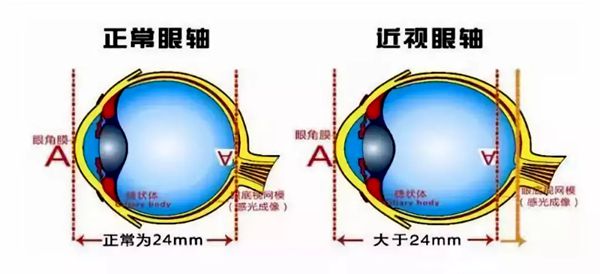 人為什么會近視,近視眼形成的原理是什么